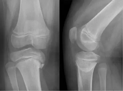 Radiograph from the case bank: Blount disease (tibia vara)