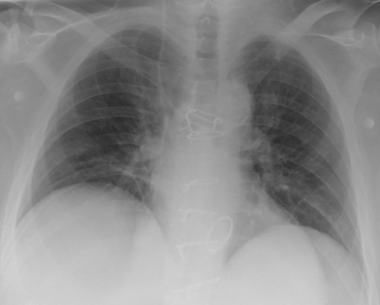 Lines & tubes radiograph for self-assessment