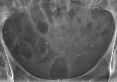 Radiograph from the case bank: Pelvic phleboliths