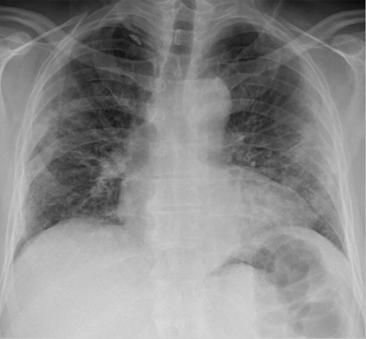 Chest radiograph for self-assessment
