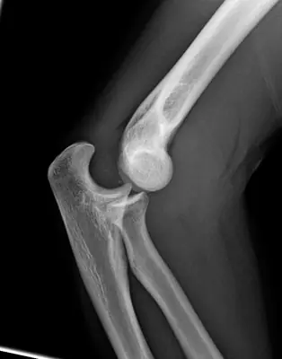 Radiograph from the case bank: Elbow dislocation