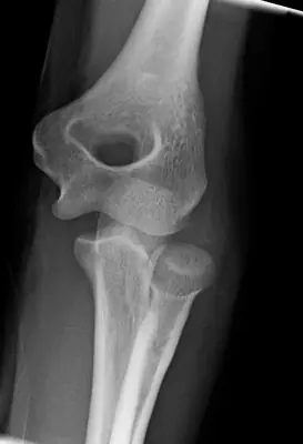 Radiograph from the case bank: Elbow dislocation