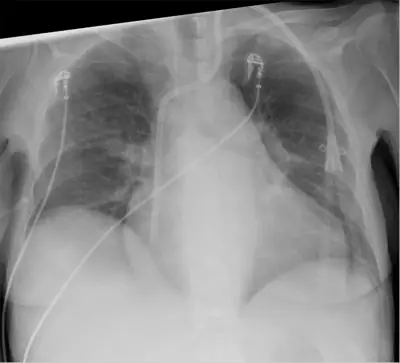 Radiograph from the case bank: Dialysis catheter