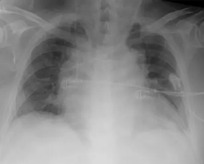 Radiograph from the case bank: Dialysis catheter
