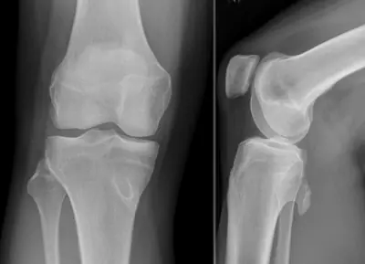 Radiograph from the case bank: Osteochondroma (exostosis)