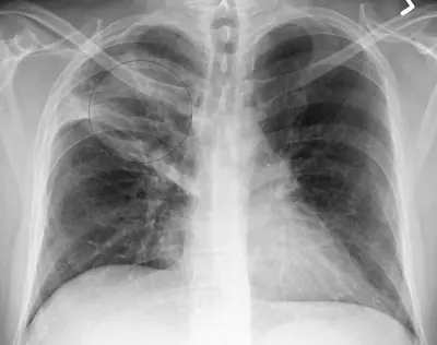 Radiograph from the case bank: Pneumonia (consolidation)