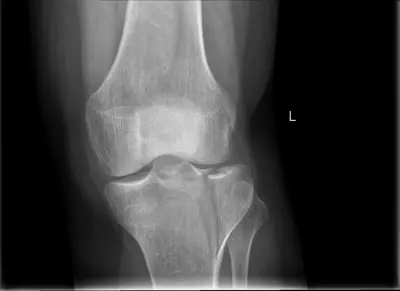 Radiograph from the case bank: Tibial plateau fracture