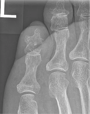 Radiograph from the case bank: Gout