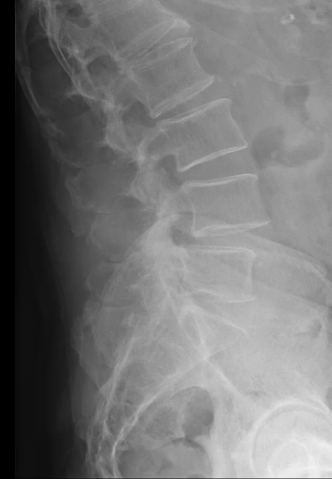 Spine radiograph for self-assessment