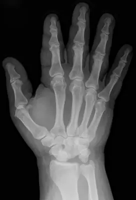Radiograph from the case bank: Carpal or carpometacarpal dislocation