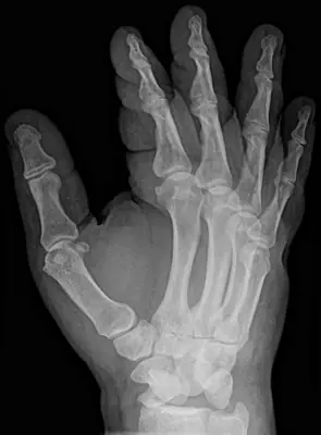 Radiograph from the case bank: Carpal or carpometacarpal dislocation