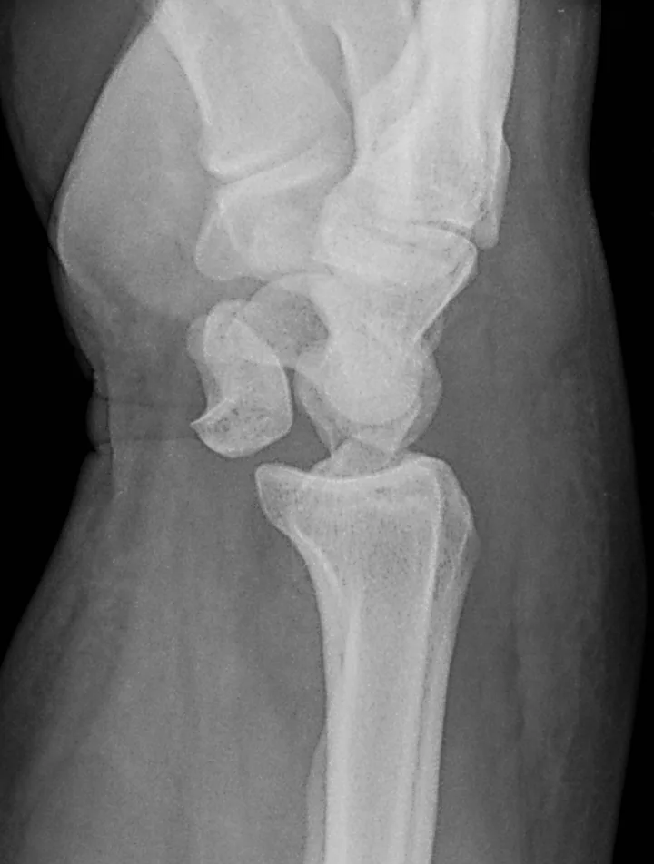 Upper limb radiograph for self-assessment