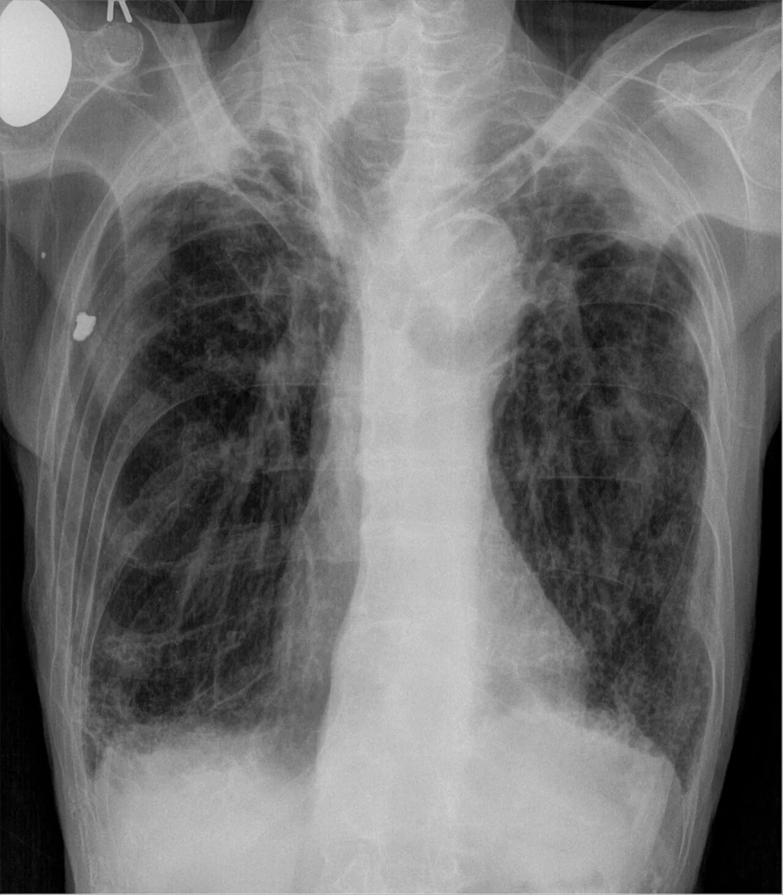 Chest radiograph for self-assessment