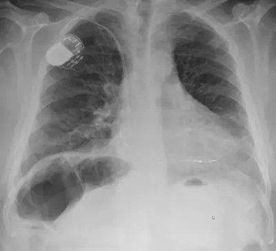 Radiograph from the case bank: Chilaiditi sign (colon interposed under the diaphragm)