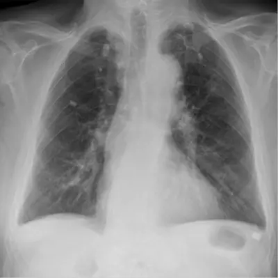 Radiograph from the case bank: Pulmonary tuberculosis