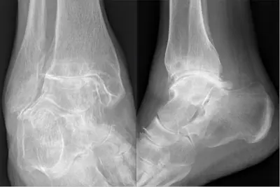 Radiograph from the case bank: Osteoarthritis