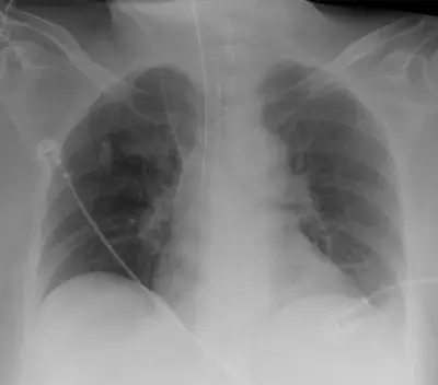 Radiograph from the case bank: Endotracheal tube