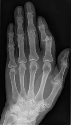 Radiograph from the case bank: Finger (interphalangeal) dislocation