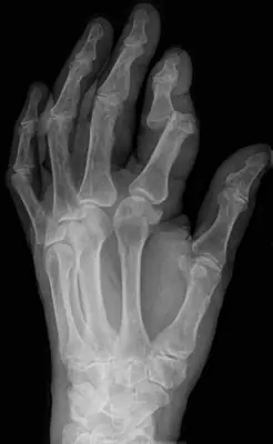 Radiograph from the case bank: Finger (interphalangeal) dislocation