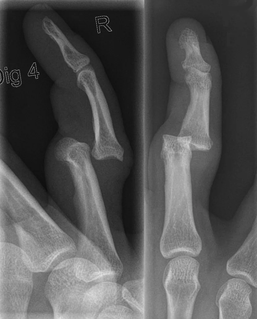 Upper limb radiograph for self-assessment