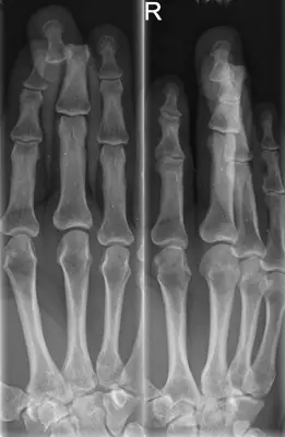 Radiograph from the case bank: Finger (interphalangeal) dislocation