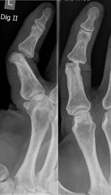 Radiograph from the case bank: Finger (interphalangeal) dislocation