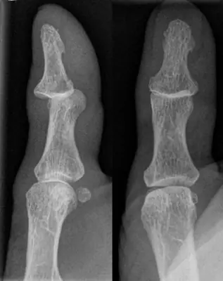 Radiograph from the case bank: Finger (interphalangeal) dislocation