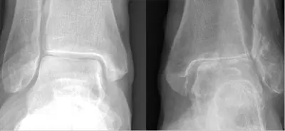 Radiograph from the case bank: Osteoarthritis