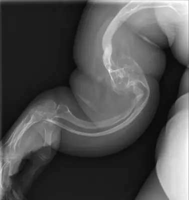 Radiograph from the case bank: Osteogenesis imperfecta