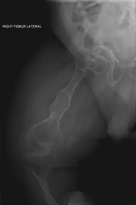 Radiograph from the case bank: Osteogenesis imperfecta