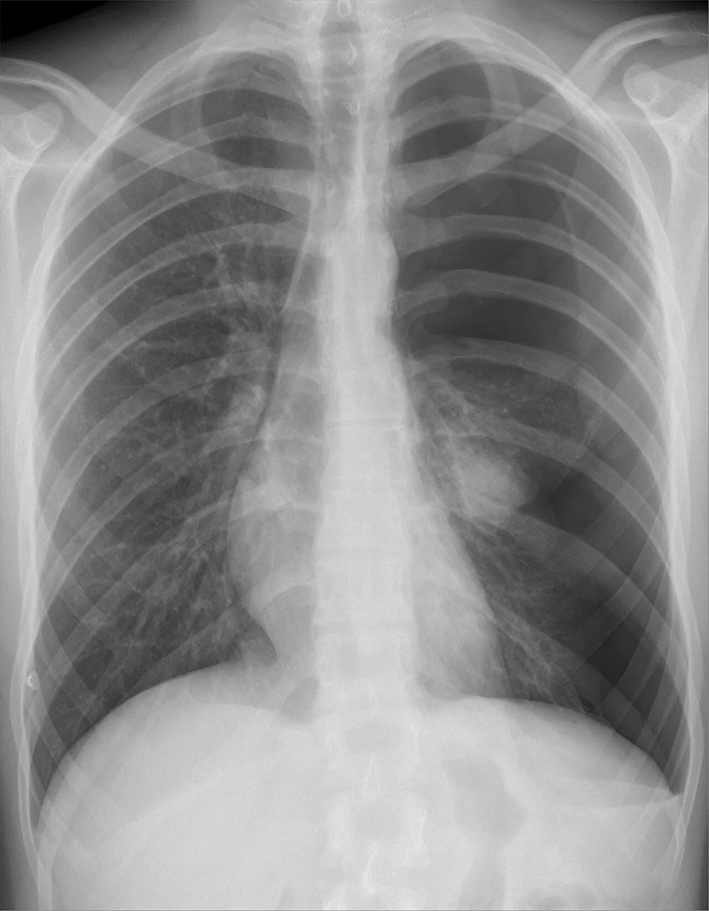 Chest radiograph for self-assessment