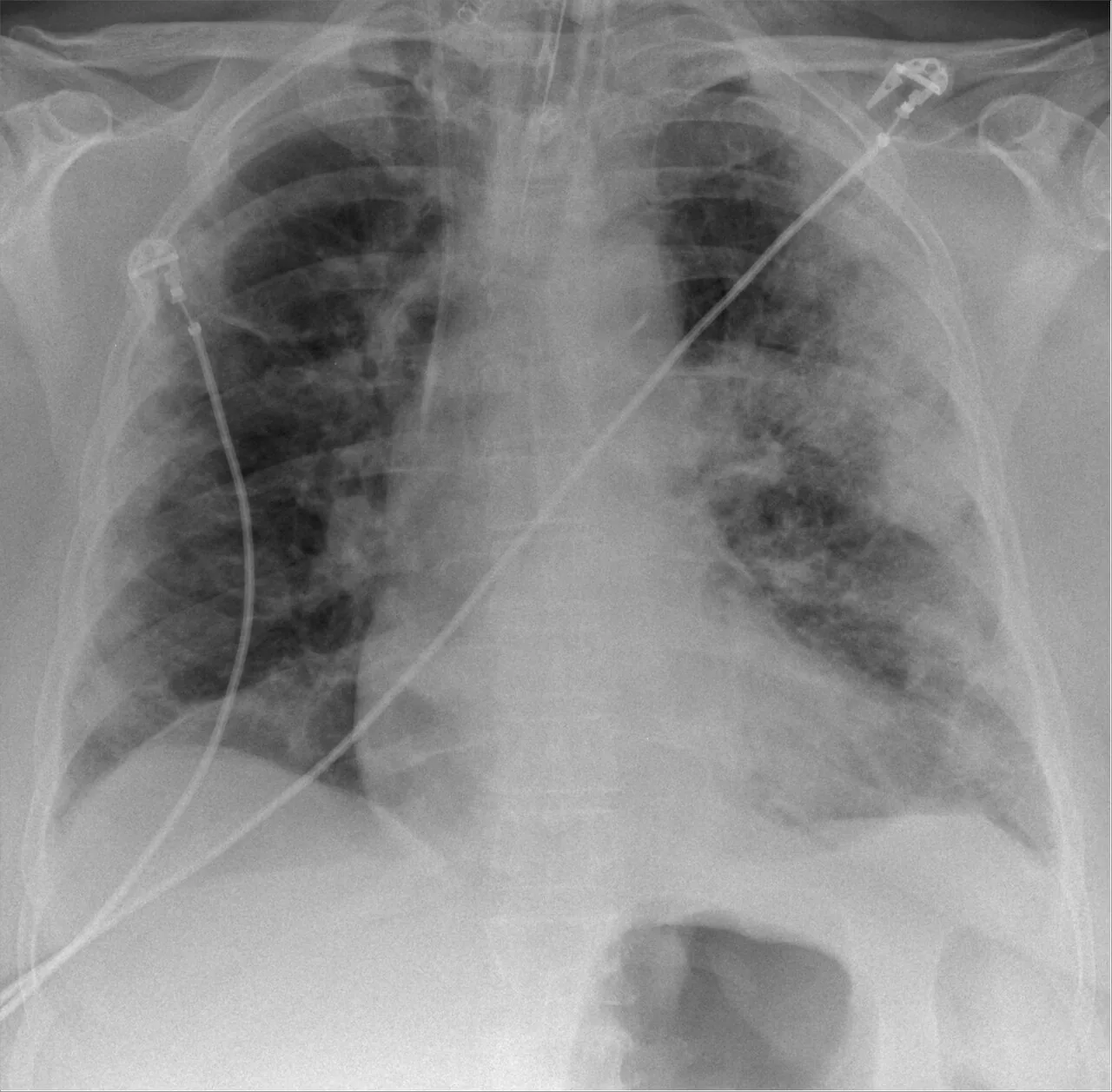 Chest radiograph for self-assessment
