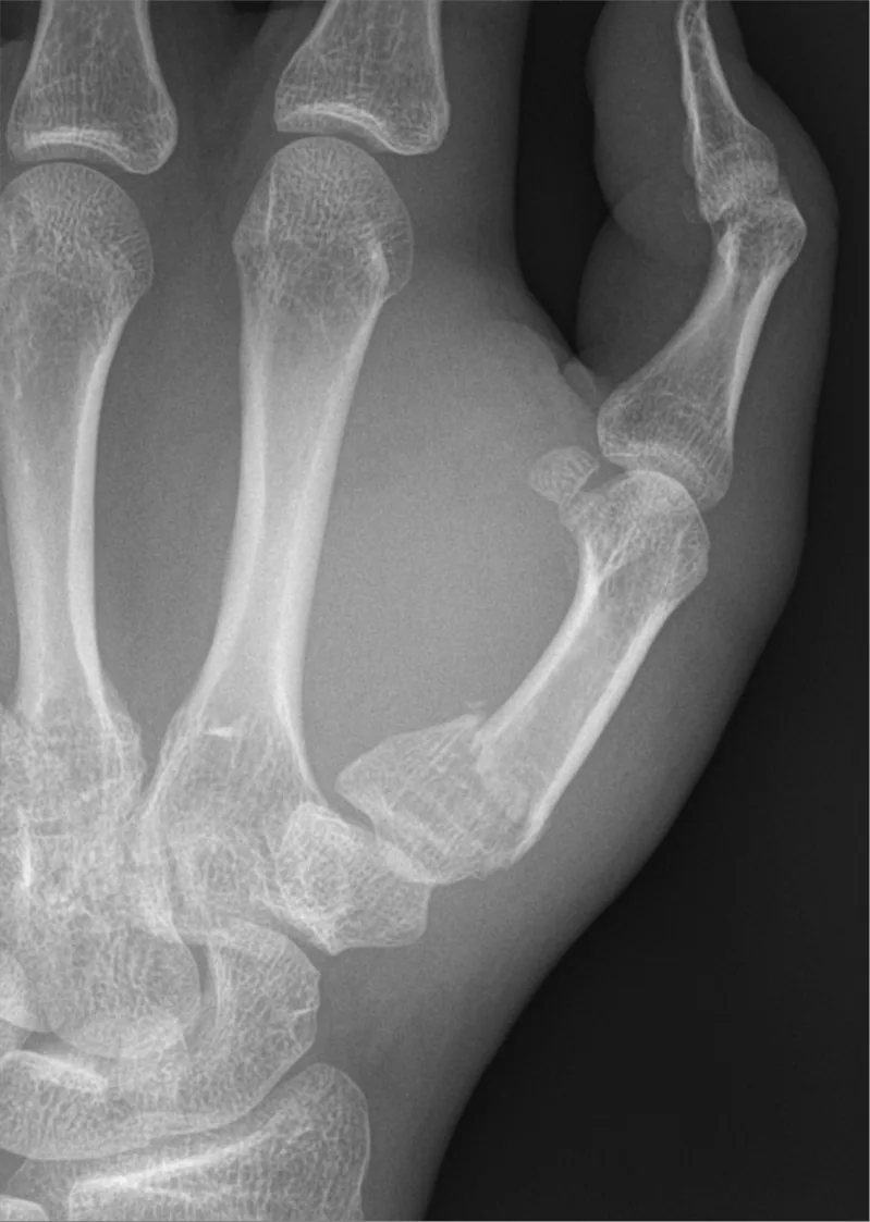 Upper limb radiograph for self-assessment