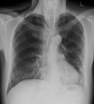 Radiograph from the case bank: Pneumomediastinum