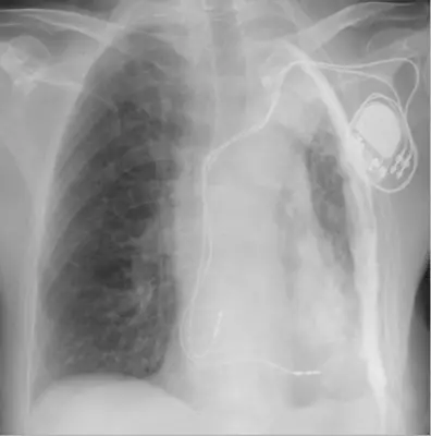 Radiograph from the case bank: Pulmonary tuberculosis