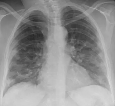 Radiograph from the case bank: COVID-19 pneumonia