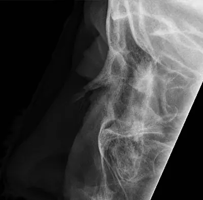 Radiograph from the case bank: Nasal bone fracture