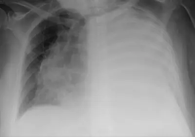 Radiograph from the case bank: Pleural effusion