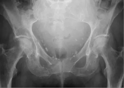Radiograph from the case bank: Pelvic phleboliths
