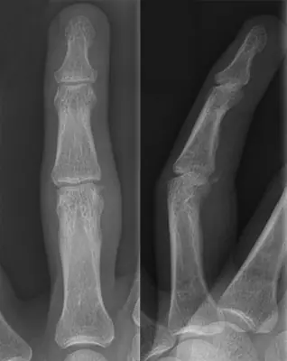 Radiograph from the case bank: Finger (phalangeal) fracture