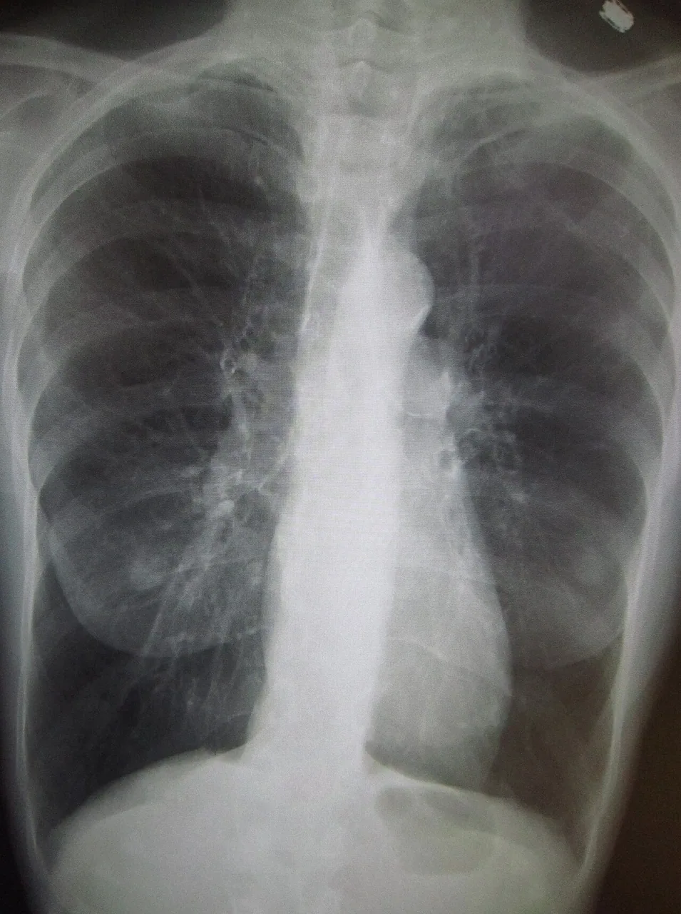 Chest radiograph for self-assessment
