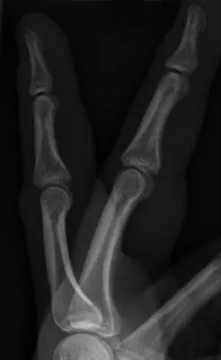 Radiograph from the case bank: Finger (phalangeal) fracture