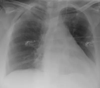Radiograph from the case bank: Central venous catheter