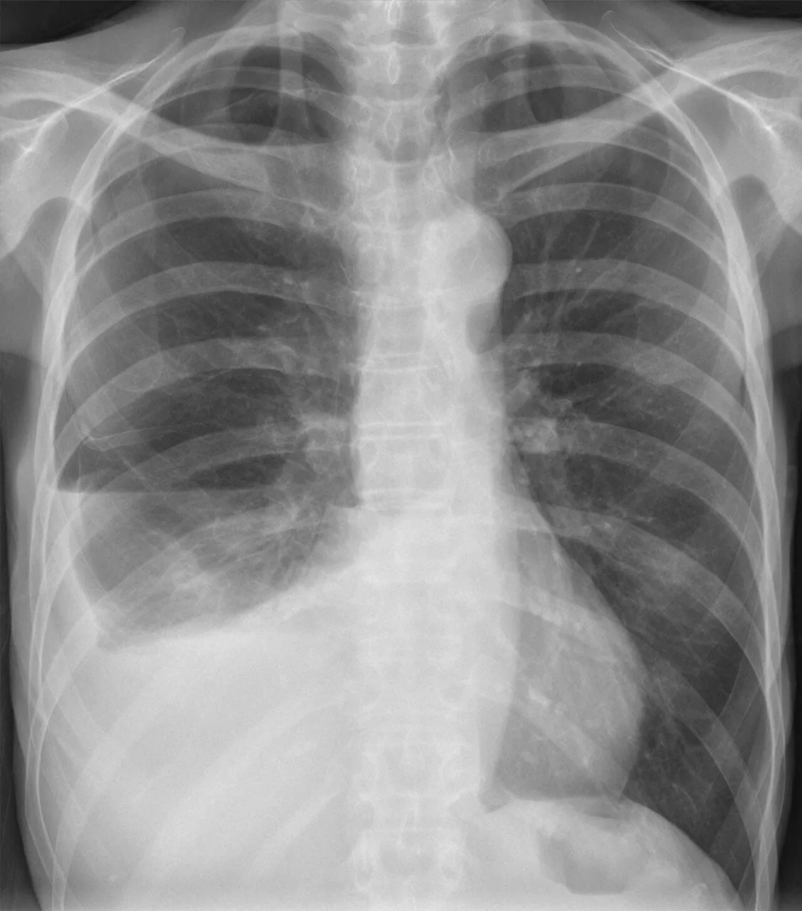 Chest radiograph for self-assessment
