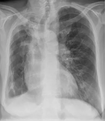 Radiograph from the case bank: Pulmonary tuberculosis