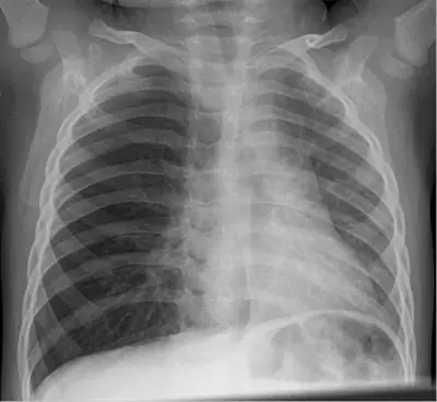 Radiograph from the case bank: Inhaled (aspirated) foreign body