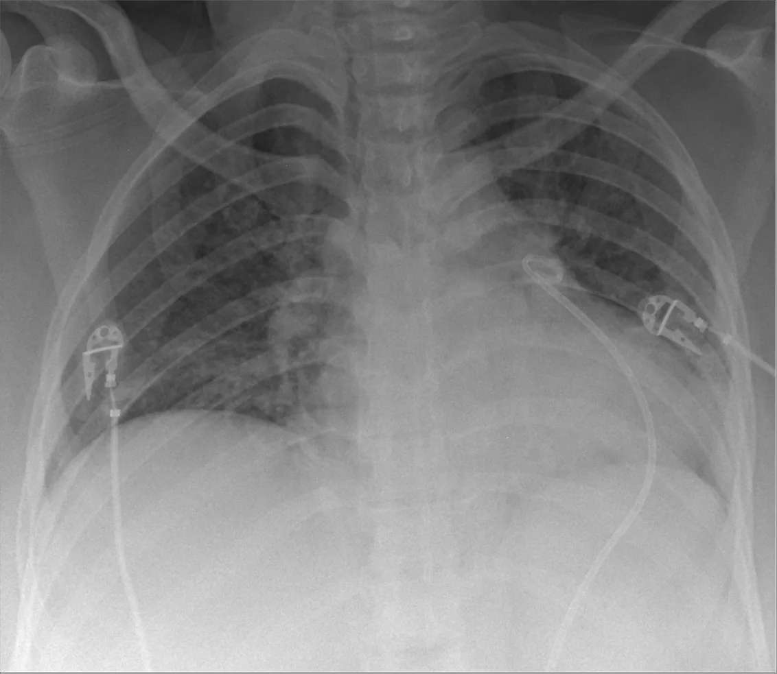Chest radiograph for self-assessment
