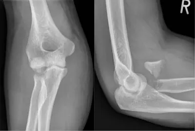 Radiograph from the case bank: Radial head fracture