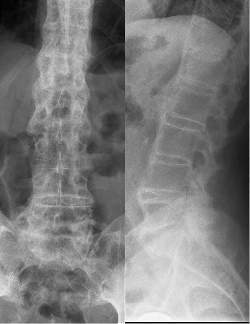 Spine radiograph for self-assessment