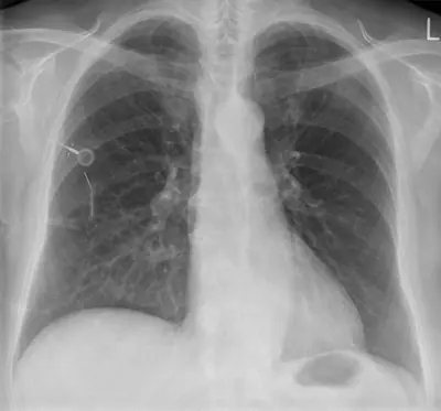 Radiograph from the case bank: Implanted venous access port (port-a-cath)